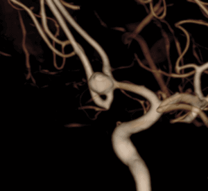 Dr. Hellinger Provides first WEB treatment of cerebral aneurysm