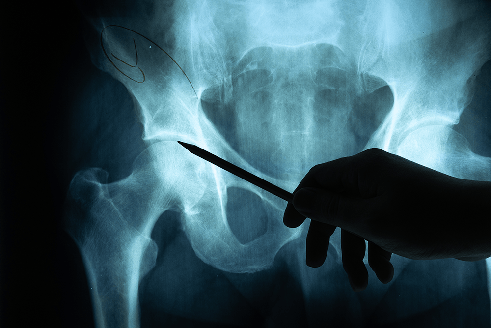 sacroiliac joint x ray