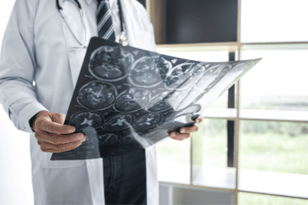 A doctor examines the imaging results of a brain scan from a patient suspected of having a Glioblastoma