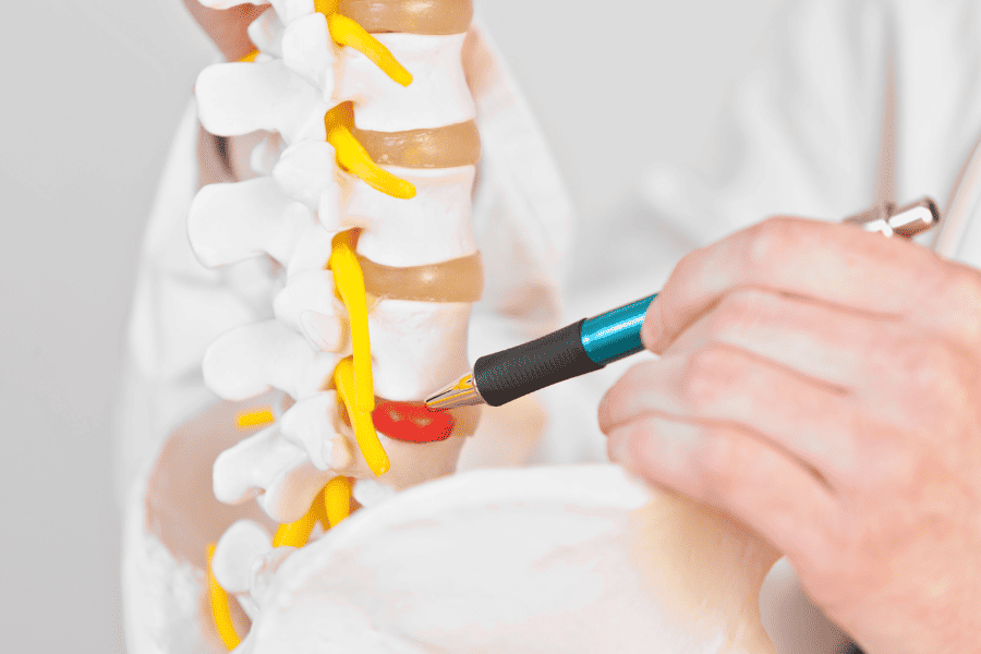 Medical Professional pointing out herniated disc on model of spinal column
