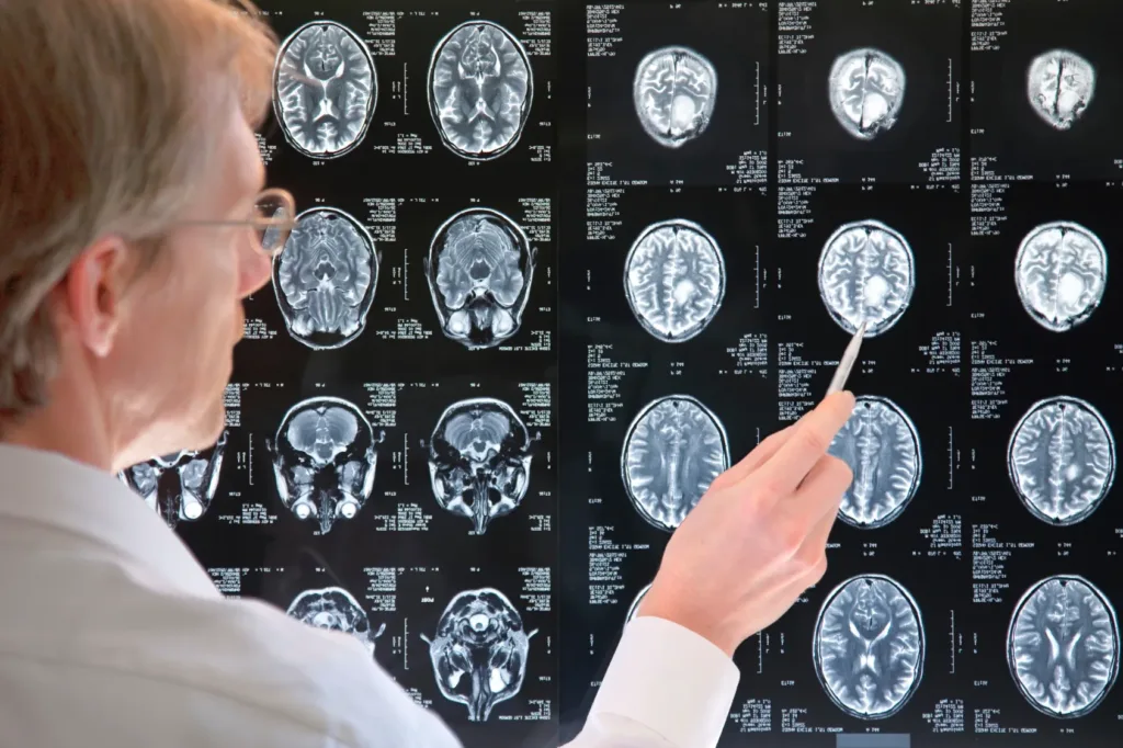 Woman pointing to a brain diagram during a diagnostic consultation at Orlando Neurosurgery